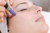 Picture of Cape Fear Acupuncture - Micro-needling